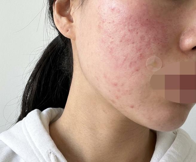 수면으로 안 아프게 받고 하루 만에 결 개선까지 느꼈어요~ㅎㅎ