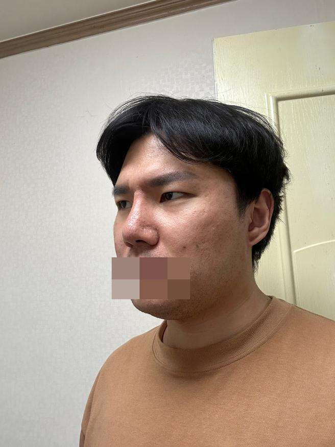 男性目元矯正