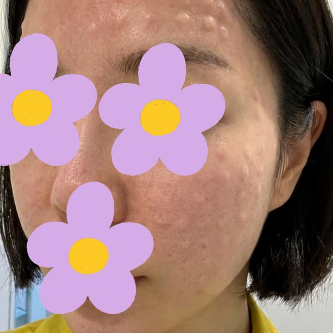 리쥬란 3일차 후기 !  홍조는 남았는데 피부가 촉촉해진 게 느껴져요