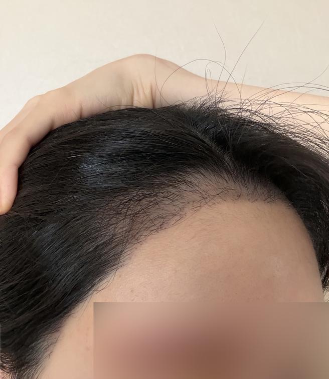 무삭발모발이식