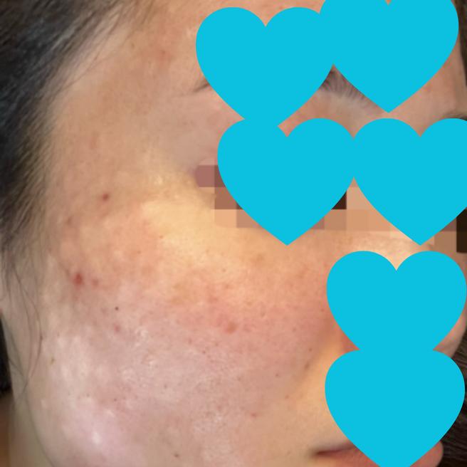 리쥬란 1일차, 수면으로 편안하게 받은 후기