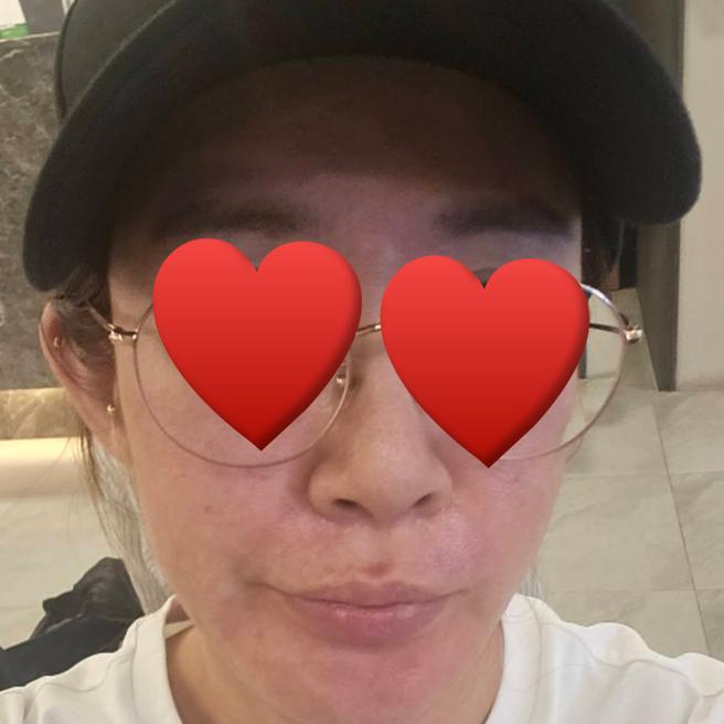 서울아이성형외과에서 쥬베룩 맞았어요~ 친절하고 꼼꼼하게 잘해주셨어요!