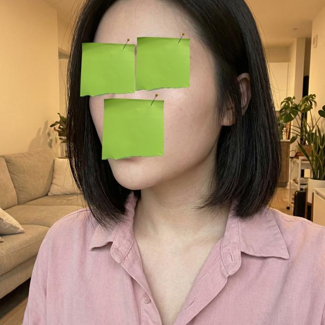 리쥬란 맞고 2주, 피부 톤이 이렇게 달라짐