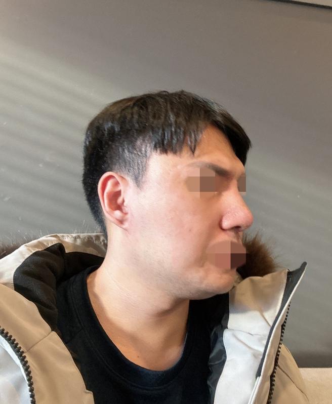 男性隆鼻術