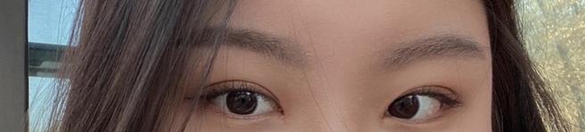 Partial incision double eyelid