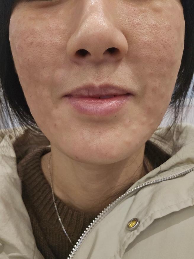 리쥬란 2주차 후기! 친절하고 안 아팠어요