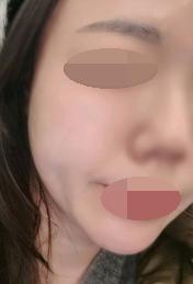 리쥬란 맛집이라 벌써 5회째 다니고 있어요 ㅎㅎ
