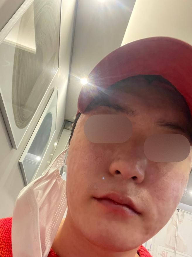 리쥬란 3일차, 겨울 푸석피부가 촉촉해졌어요
