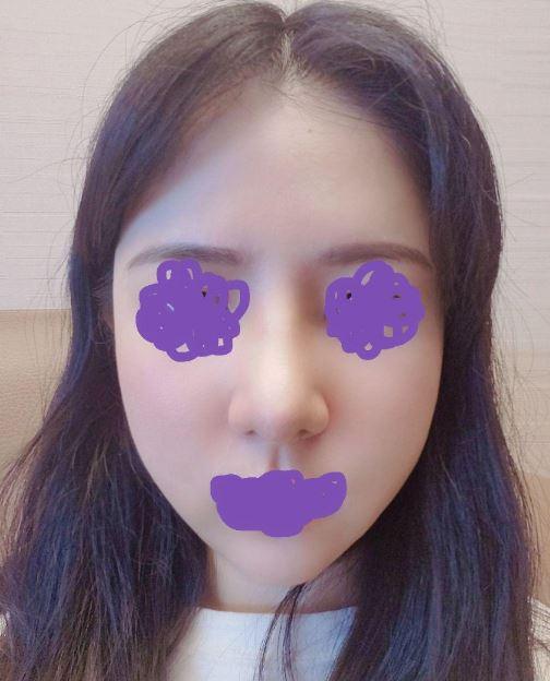 ศัลยกรรมจมูกครั้งแรก
