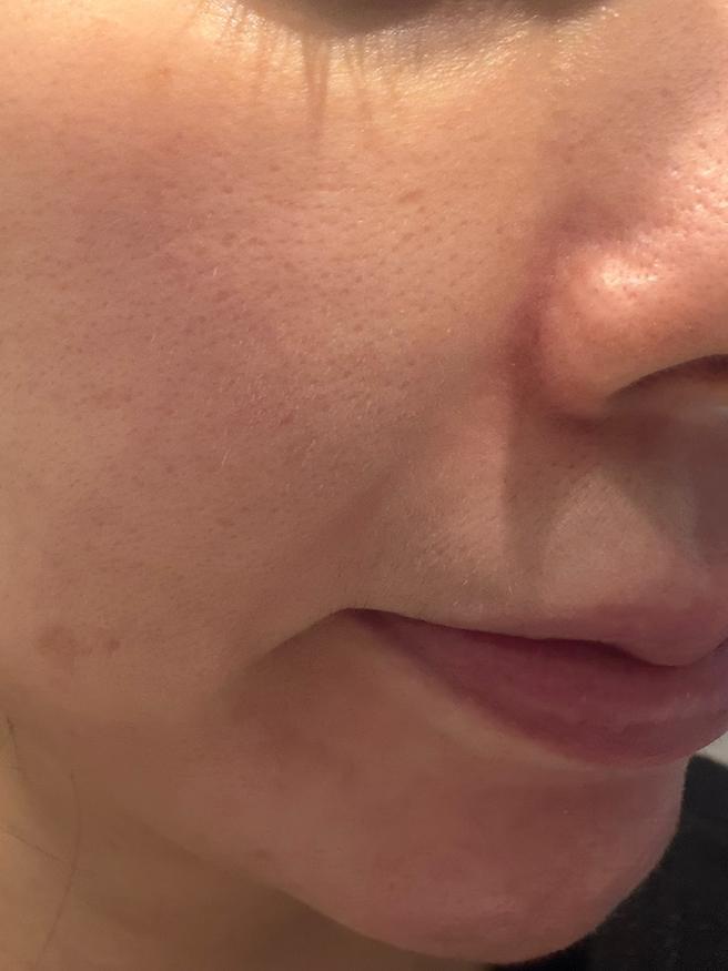 리쥬베룩 맞고 3일째입니다!! 붉은 기 있는데 피부 속은 촉촉한 느낌?