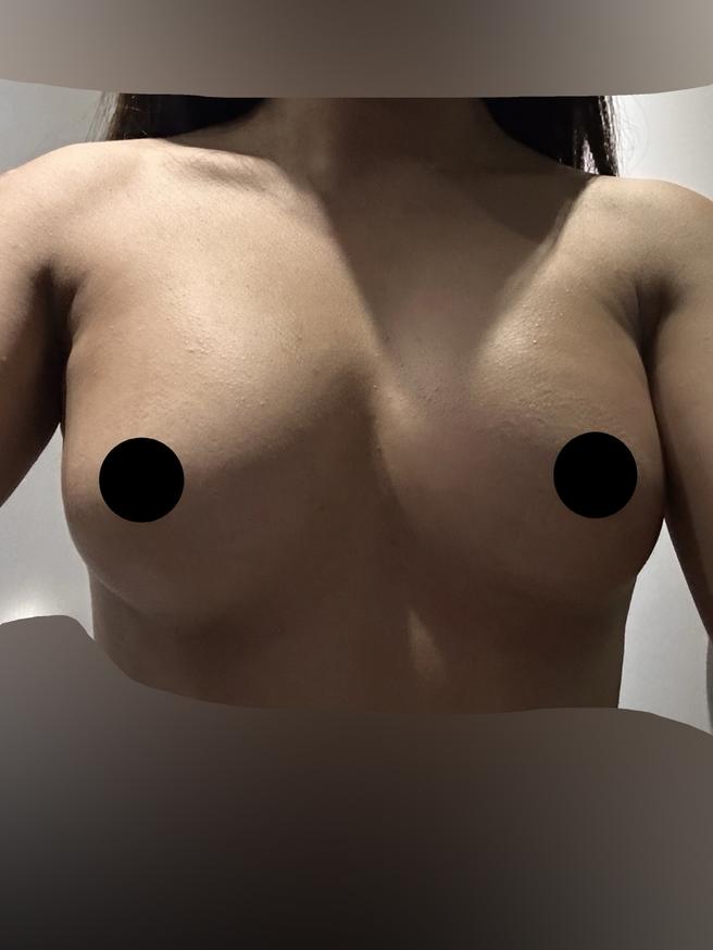 PRPを用いた胸への脂肪移植