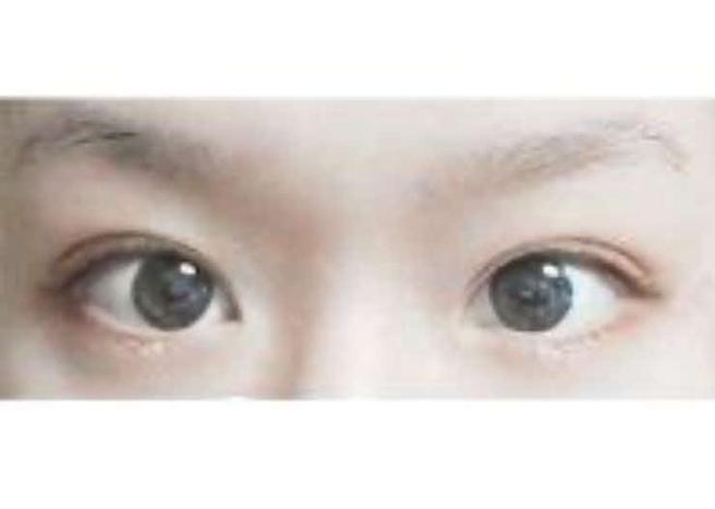 눈매교정 쌍수~~