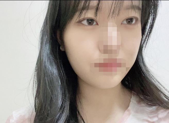 안심 눈 재수술
