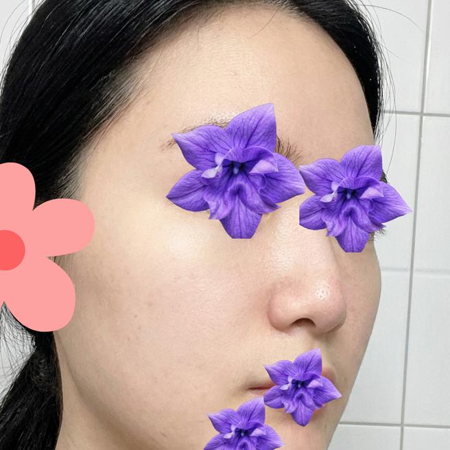 사각턱 보톡스 처음 맞아본 후기 (시술 2일차)