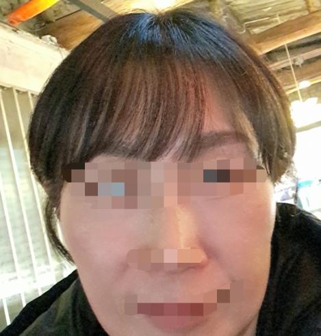 리쥬란 3일됐어요 피부 컨디션 회복 중