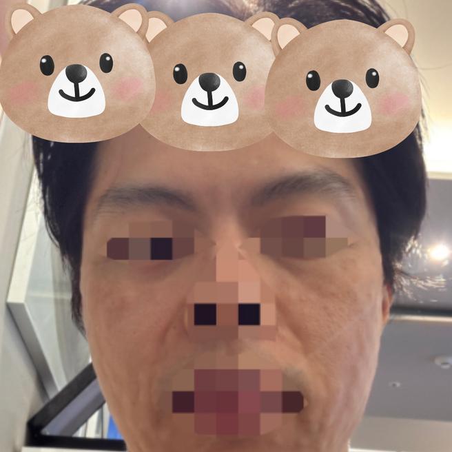 눈가 주름 고민으로 받은 리쥬란아이 당일 후기