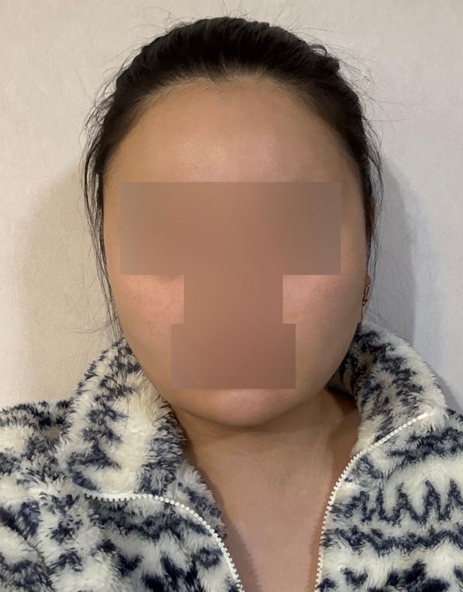 얼굴 지방흡입