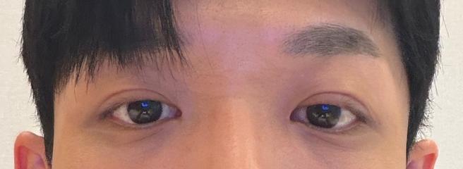 남자 눈매교정
