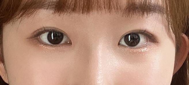 눈매교정&안검하수
