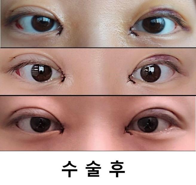 눈매교정&안검하수