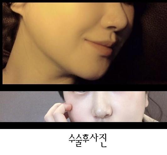ศัลยกรรมจมูกครั้งแรก