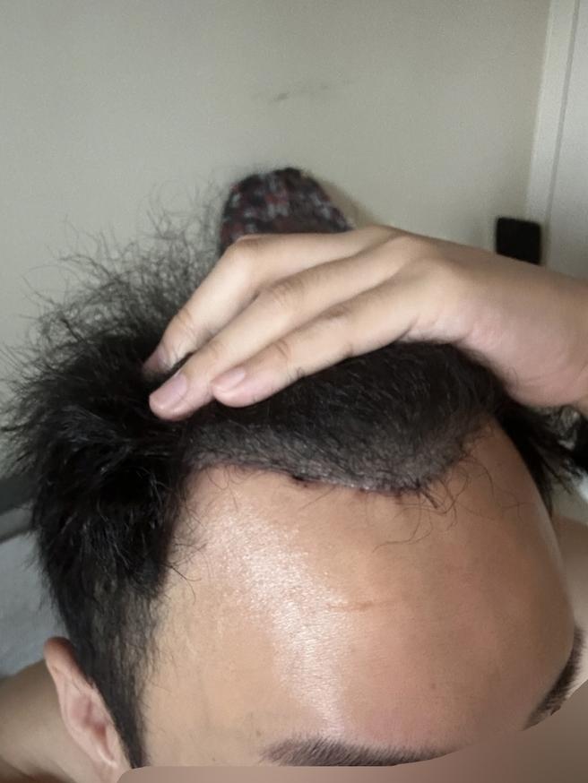 额头缩小术