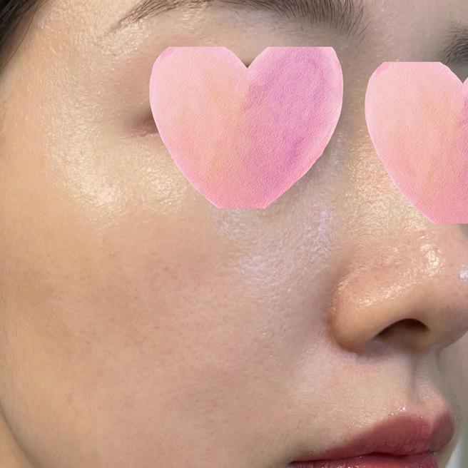  쥬베룩+연어주사 당일 후기 — 재생크림 바르고 나왔는데 피부가 촉촉해요 ㅎㅎ
