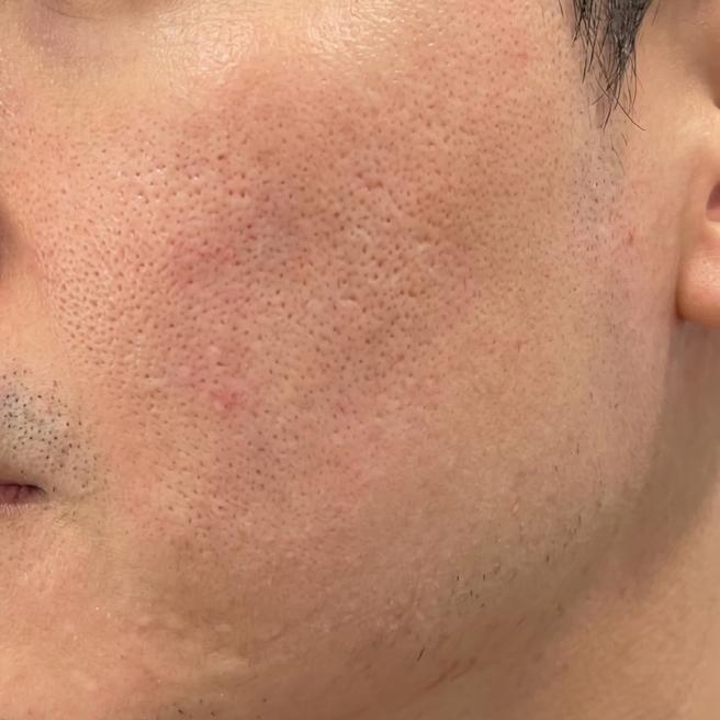 30대 남자 리쥬란 힐러 첫 경험, 시술 직후 컨디션이에요