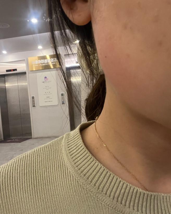 사각턱 보톡스 후기, 대기 없고 상담 친절해요