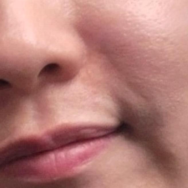 빠르고 꼼꼼한 리쥬란 시술 만족해요