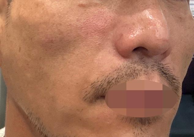 수면 리쥬란, 엠보도 확실하고 다른 병원들보다 만족도가 높습니다.