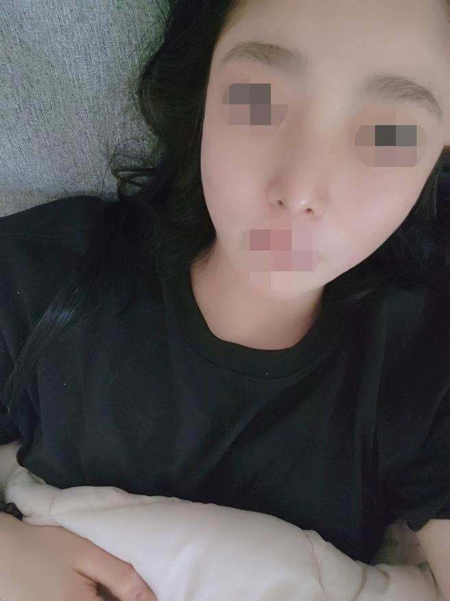 Revision Nose Surgery