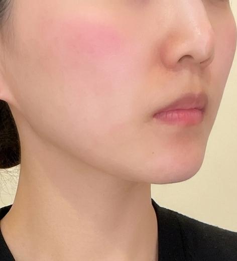 마이크로파로 진피층 자극, 얼굴 라인 정리에 딱 좋은 온다리프팅이에요