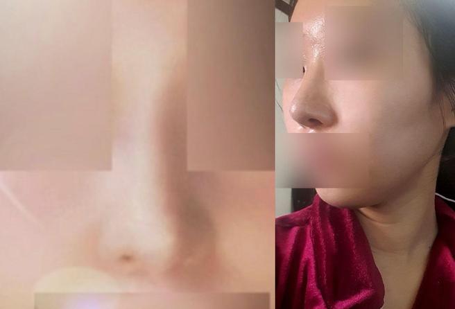 비절개콧볼축소