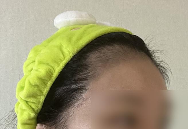 无剃发植发