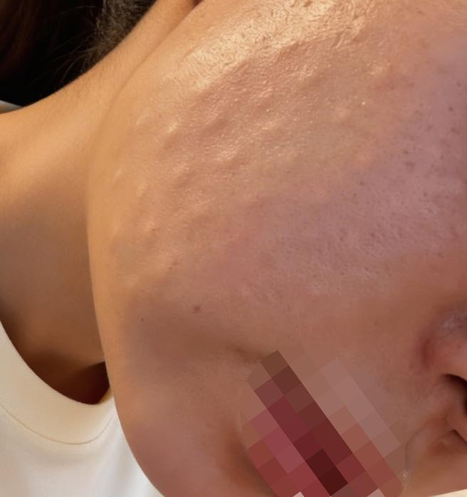피부결 고민으로 리쥬란힐러 수면으로 편하게 받아봤어요!