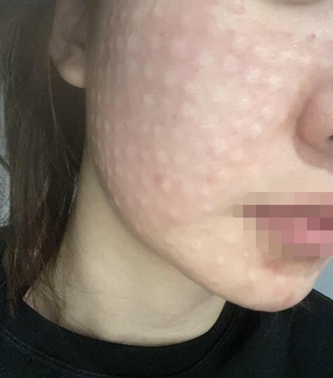 엠보 꼼꼼하게 올라와서 첫 리쥬란 결과가 너무 기대돼요~ㅎㅎ