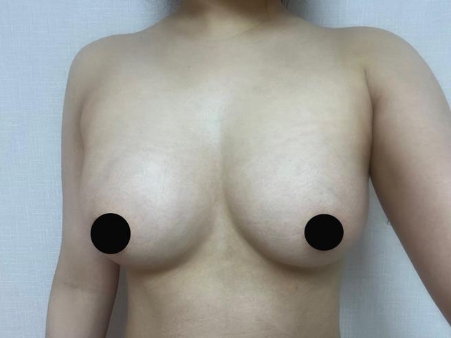 PRPを用いた胸への脂肪移植