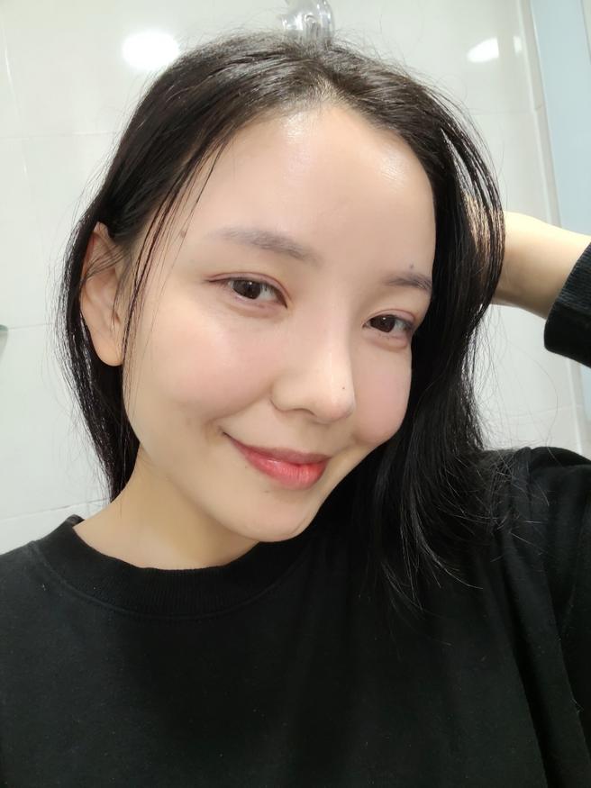 PRP 풀페이스지방이식