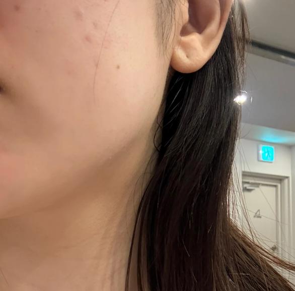 온다리프팅과 라리리쥬 받았는데 일본어 통역 있어서 최고예요 ㅎㅎ