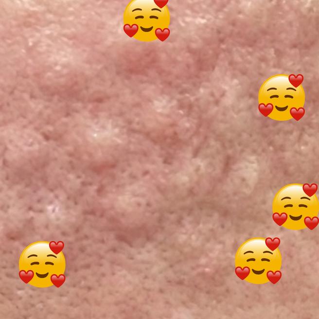 리쥬란 힐러 당일, 생각보다 부담 없이 잘 받았어요