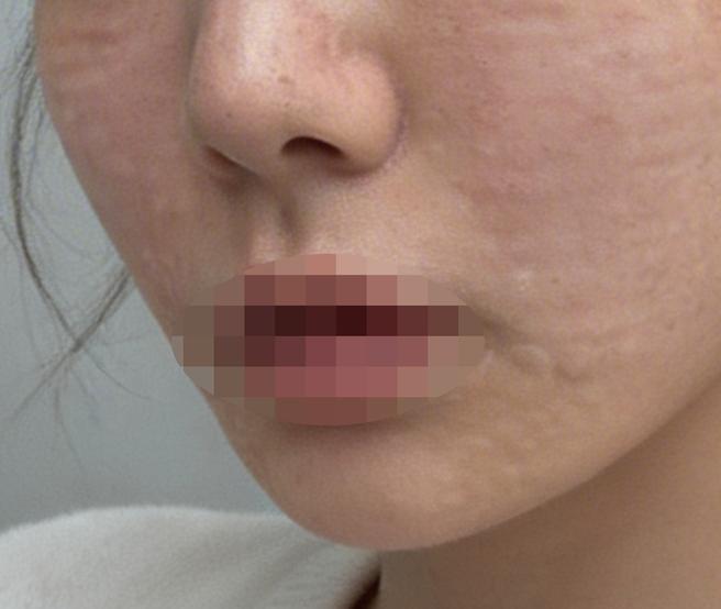 신부 관리로 피부 생기 채우려고 리쥬란 받아봤어요~!