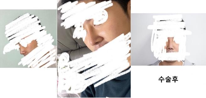 남자코성형