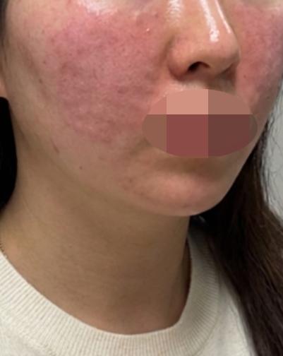 건성 피부와 잔주름까지 신경쓰여서 리쥬란 받았어요!