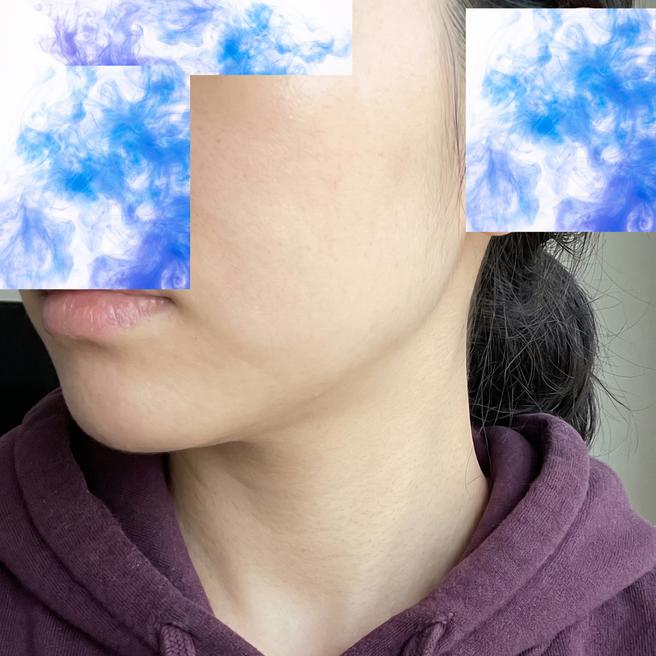 목주름이 얼굴보다 먼저 나이 들어 보여 티타늄 리프팅 받았어요 (2일차)