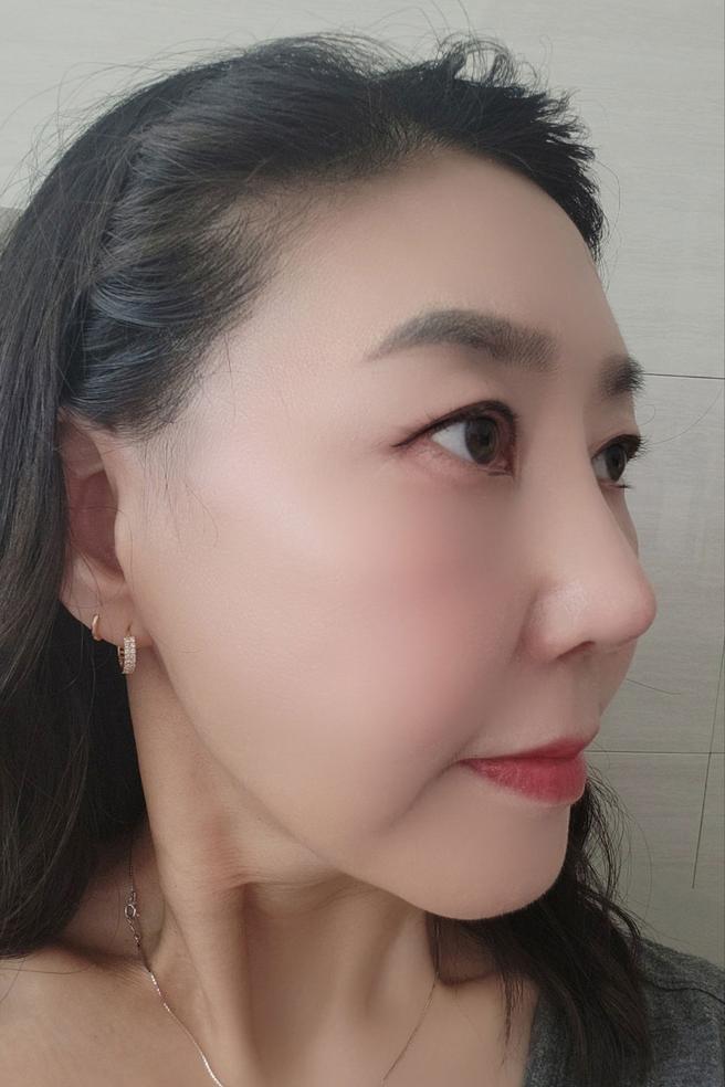 안심 코 재수술