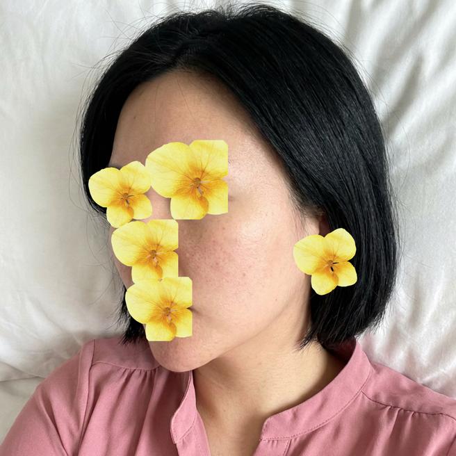 엑소좀 + 온다 리프팅 5일차, 붉은기 거의 빠지고 피부결 정돈된 느낌