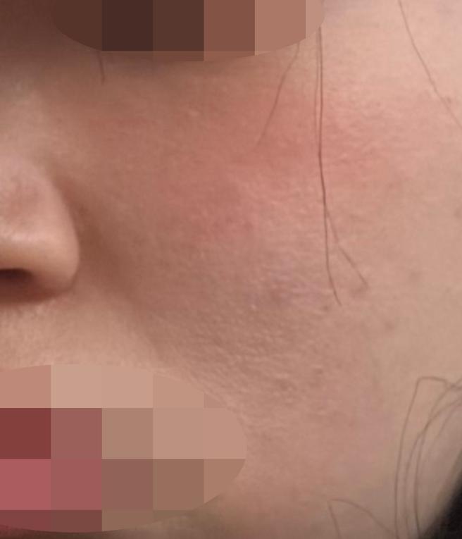 피부 당김 때문에 받았는데 만족스러워서 재방문 예정이에요!