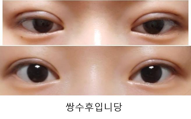 자연유착 쌍꺼풀