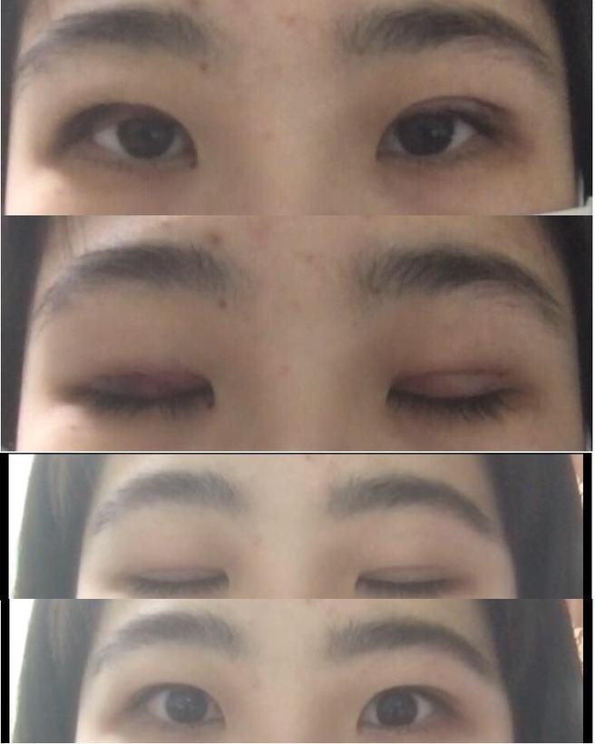 절개쌍꺼풀